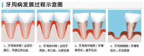 牙周炎矫正牙齿需谨记 不专业的正畸会导致牙齿松动风险 口腔资讯 牙齿矫正网