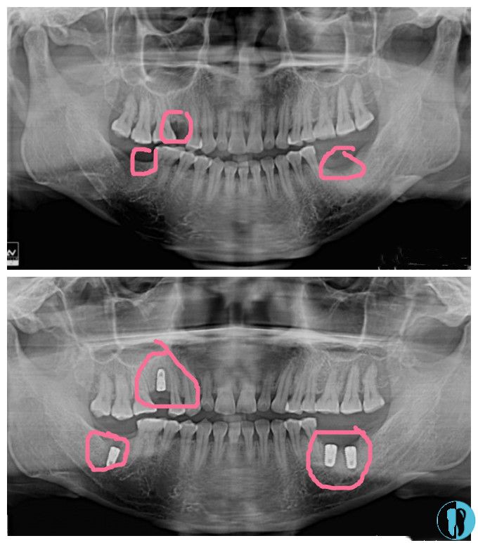 奥齿泰ts3种植体种牙前后CT对比照