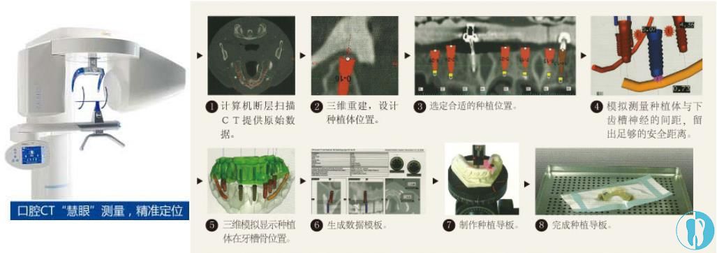 4D微创种植牙过程