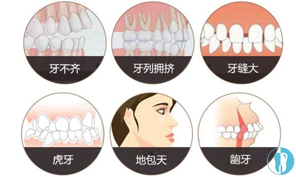 舌侧矫正适应的6种牙齿情况