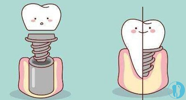 牙博士口腔三大种植牙技术