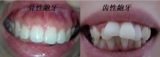 齿性龅牙和骨性龅牙图片