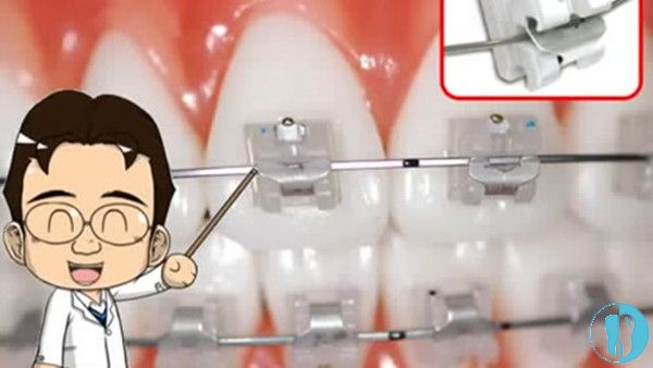 牙医讲自锁托槽矫正是啥样的