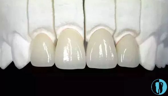 全瓷牙的硬度于牙釉质近似