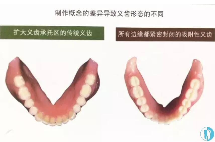 吸附性义齿和普通全口义齿区别