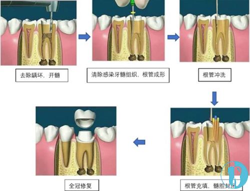 切牙管位置示意图图片