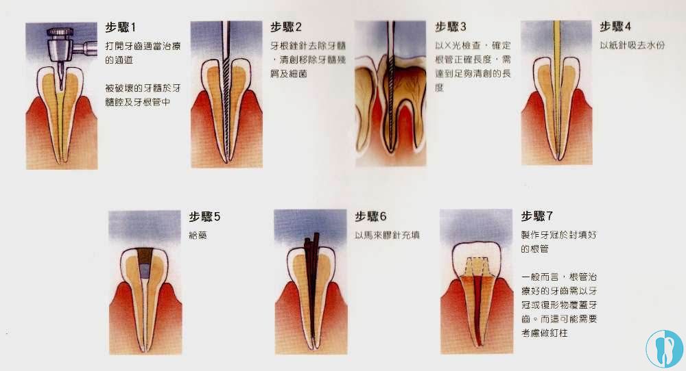 牙齿根管治疗步骤图片