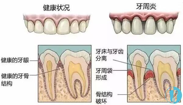牙缝变大的主要原因是牙周病