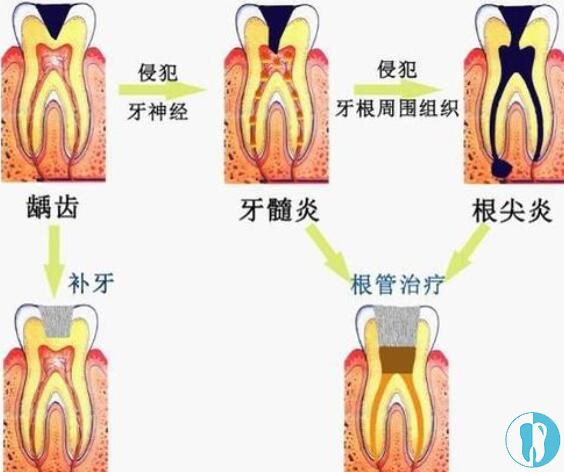 蛀牙发展过程