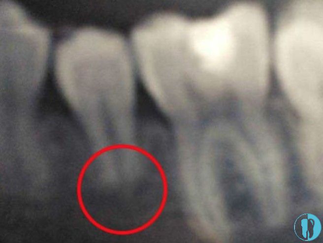 正畸中牙齿移动过快，牙根被吸收