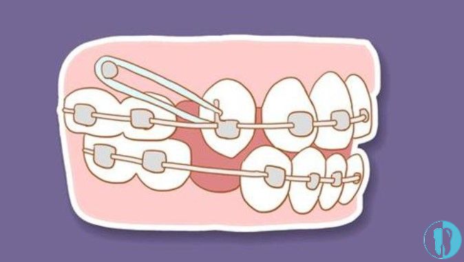 牙根吸收是牙齿矫正后遗症中的一种