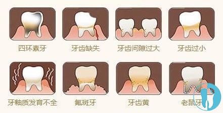 四环素牙、氟斑牙都可通过瓷贴面来改善
