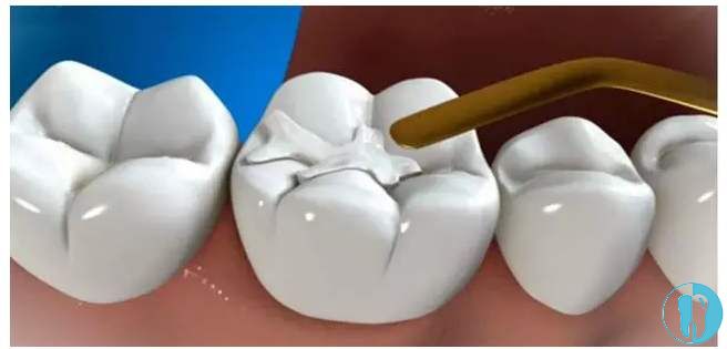 千万不要去补牙洞的原因莫非与补牙材料容易脱落有关？