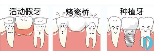 不同的缺牙修复方式