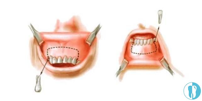 骨性和牙性区别还是比较大的