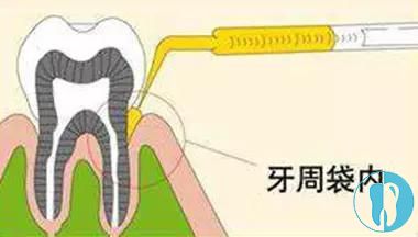 牙周袋处理方法