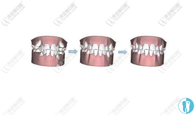 牙齿矫正过程图示