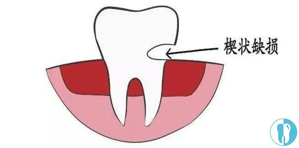 牙齿楔状缺损外观示意图