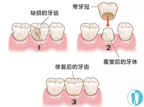 全瓷牙修复牙体缺损的过程图
