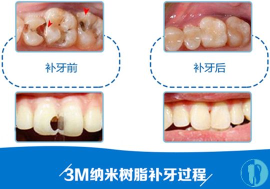 叶金平医生科普牙齿缺损的修复方式都有哪些