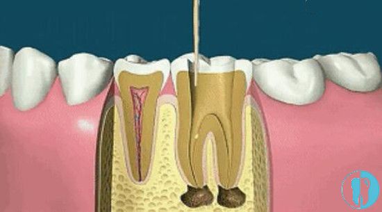 牙齿做根管治疗的详细步骤图解