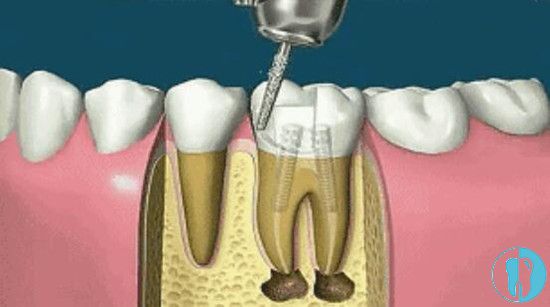 牙齿做根管治疗的方法