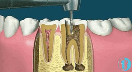 牙齿做根管治疗的过程