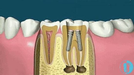 牙齿根管治疗打桩