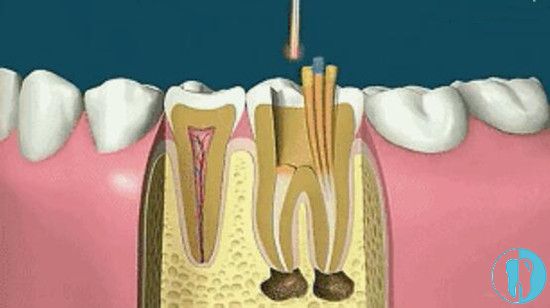 牙齿根管治疗填充根管