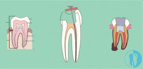 根管治疗清除感染的牙髓
