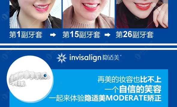  Invisalign隐形正畸新品moderate