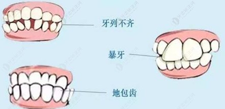 各类牙齿不齐的症状都可以通过矫正治疗