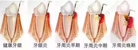 牙周炎不同程度变化图