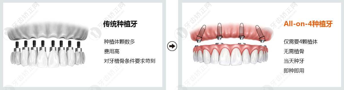 传统种植牙方式与all-on-4种植牙方式对比