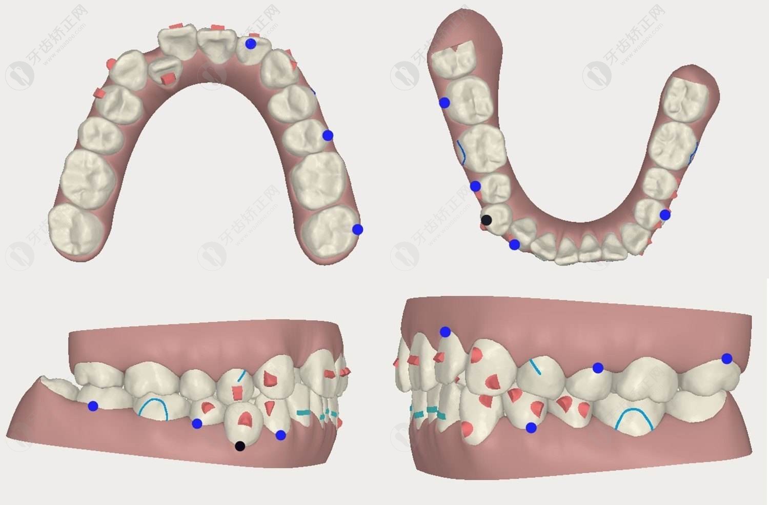 隐形矫正的牙齿移动过程