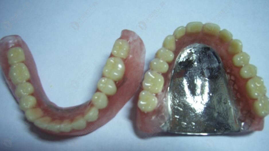 纯钛支架活动义齿图片图片