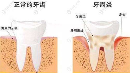 正常的牙齿和有牙周炎的牙齿