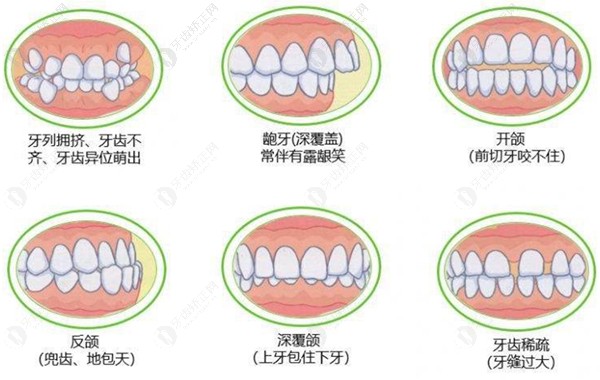 牙齿畸形的程度、类型也是决定收费的重点