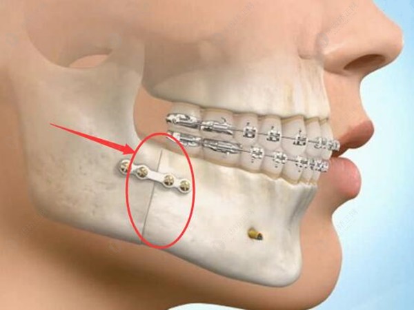 牙齿偏颌做正颌手术的风险大吗
