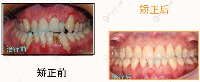 前牙反颌矫正前后图片对比