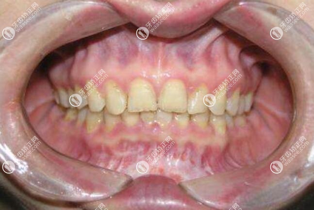 上颌尖牙舌面图片
