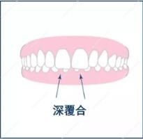 深覆合图片