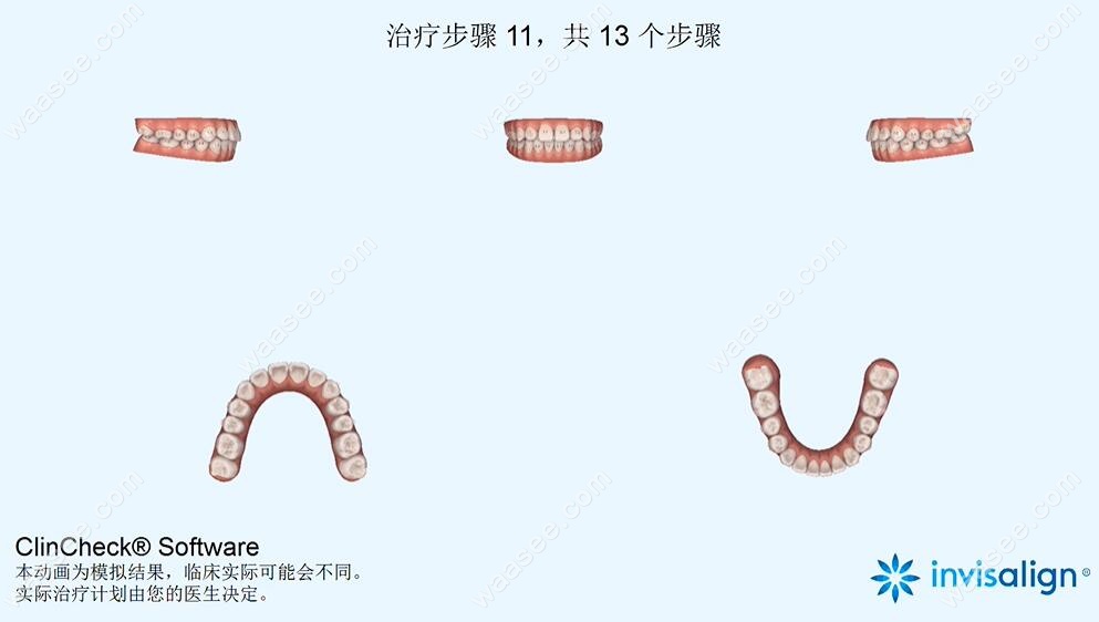 女孩矫正牙齿前3D动画演示牙齿矫正过程