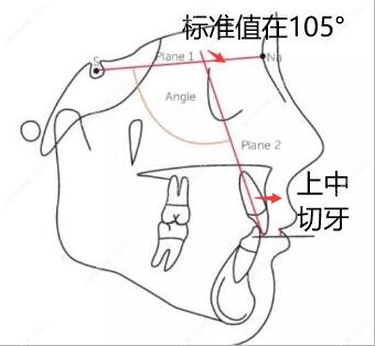 唇倾度