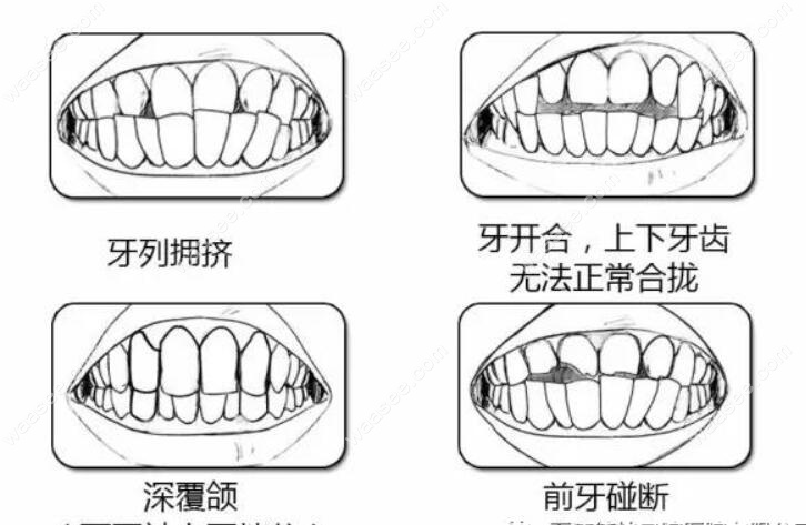 德柏口腔刘洪医生告诉大家：怎么判断自己需不需要做牙齿矫正