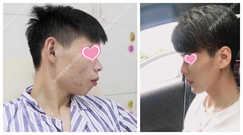 男性骨性凸嘴做正颌手术前后脸型变化对比照片