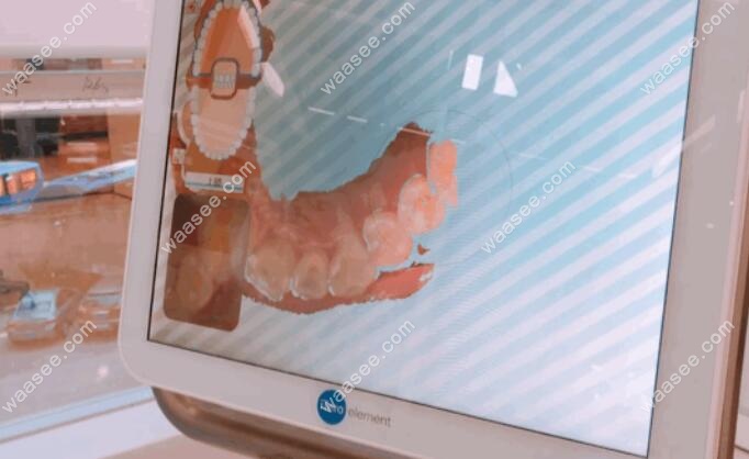 电脑上显示的牙齿矫正模拟过程