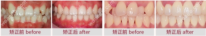 上海雅悦齿科口腔隐形牙齿矫正案例