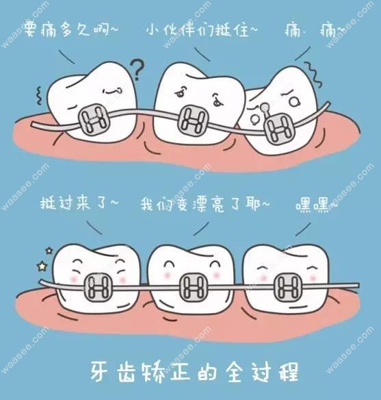 牙齿矫正的原理