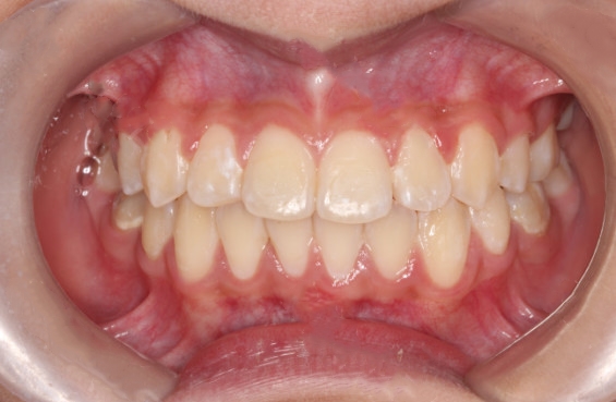 来自青岛维乐口腔的牙齿矫正案例(安氏二类错颌畸形矫治）